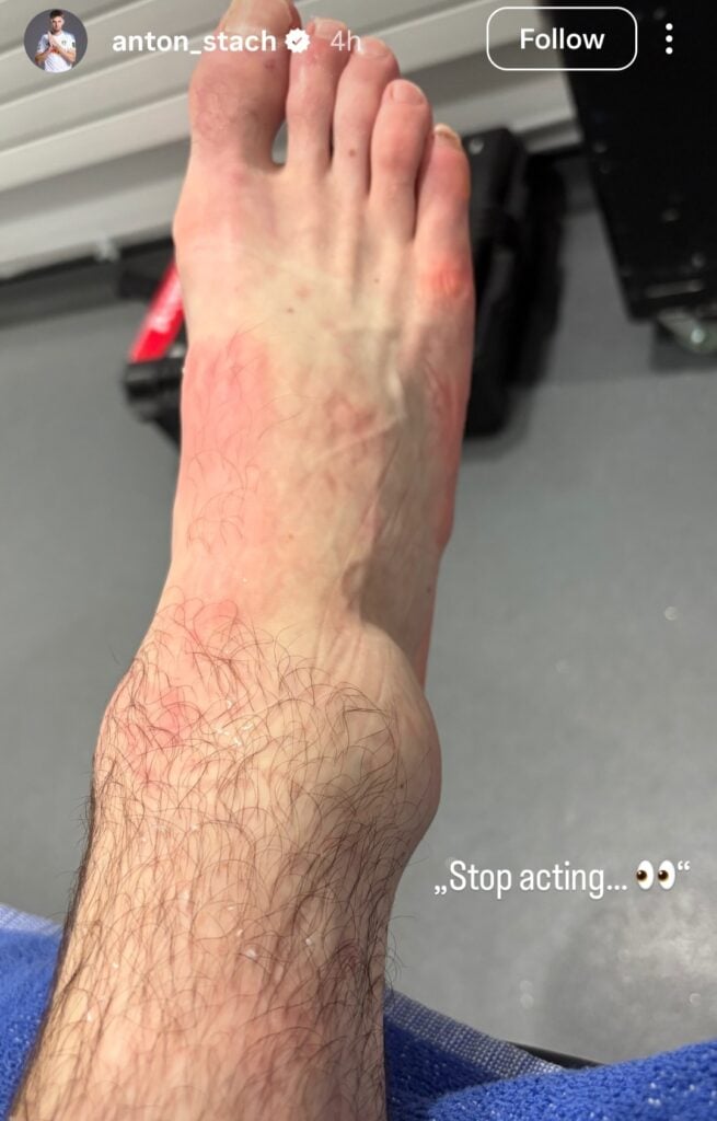 Image of Anton Stach's injury from Leeds United vs West Ham as posted via his Instagram stories